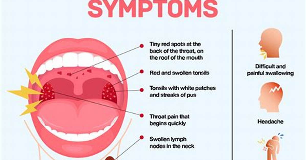 Strep Without Fever