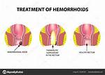 Suppository for Hemorrhoids
