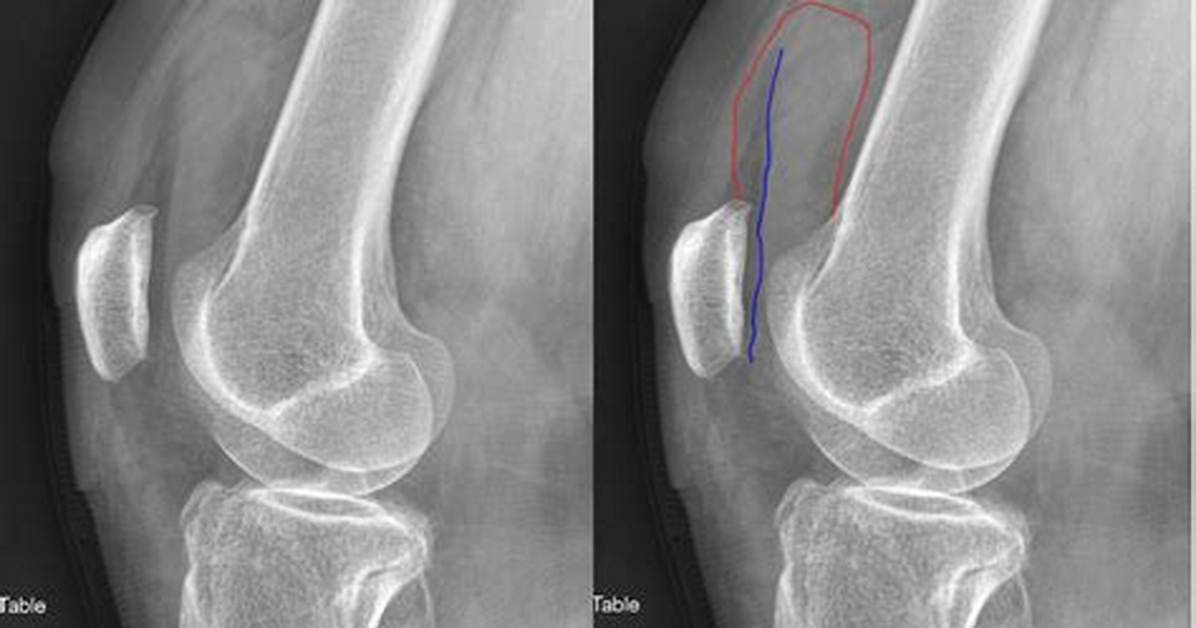 Suprapatellar Effusion