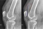 Suprapatellar Effusion