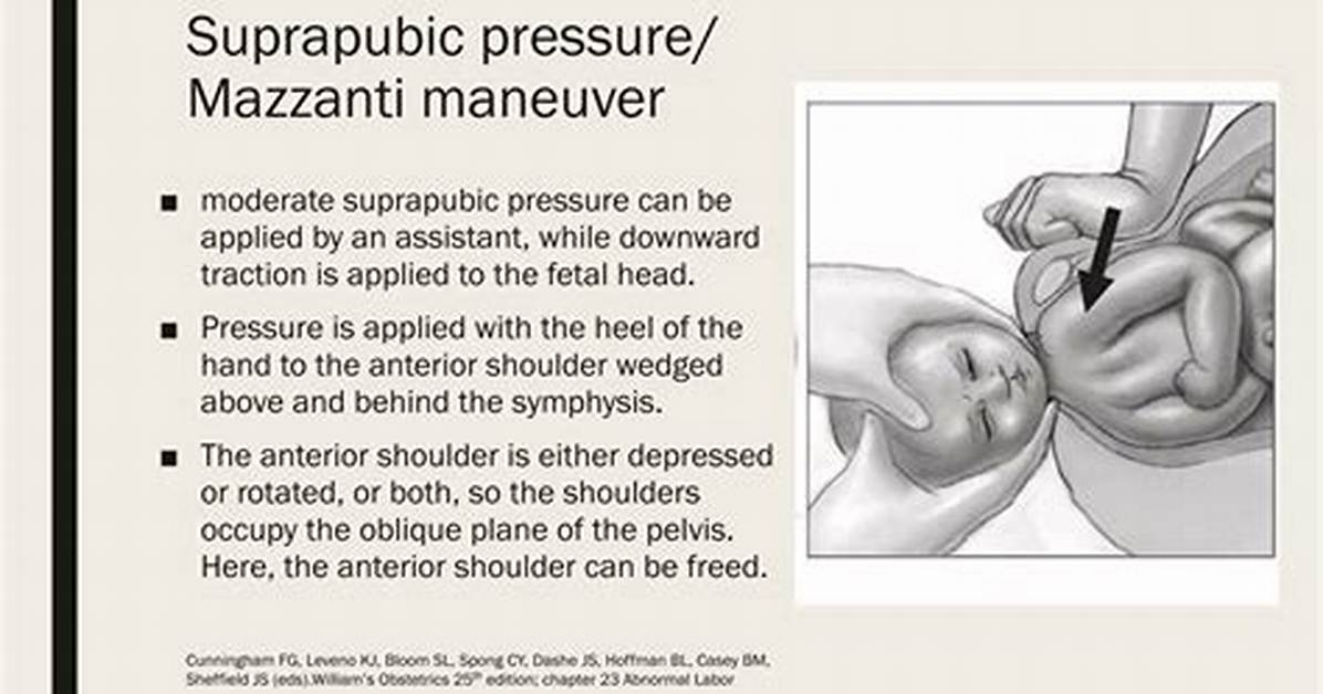Suprapubic Pressure