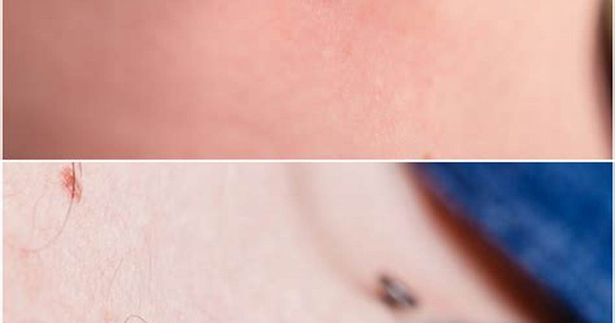 Surface Anchor Piercing