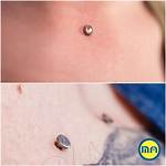 Surface Anchor Piercing