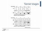 Tanner Stage 4