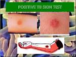 Tb Test Bruise