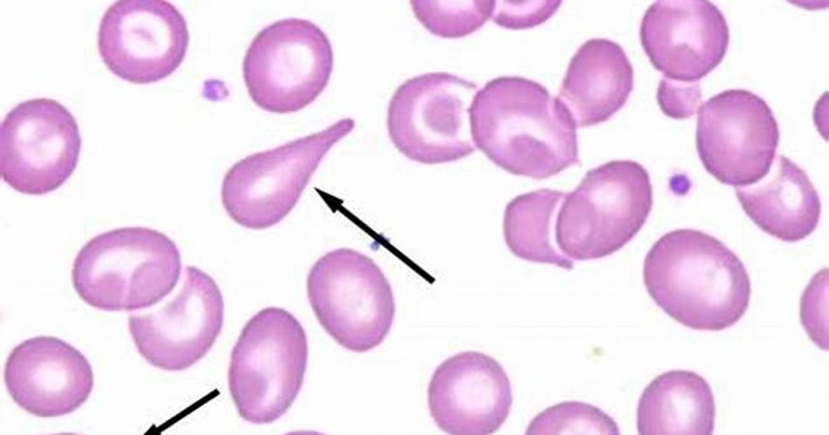Tear Drop Cells