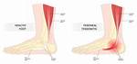Tendonitis Icd 10