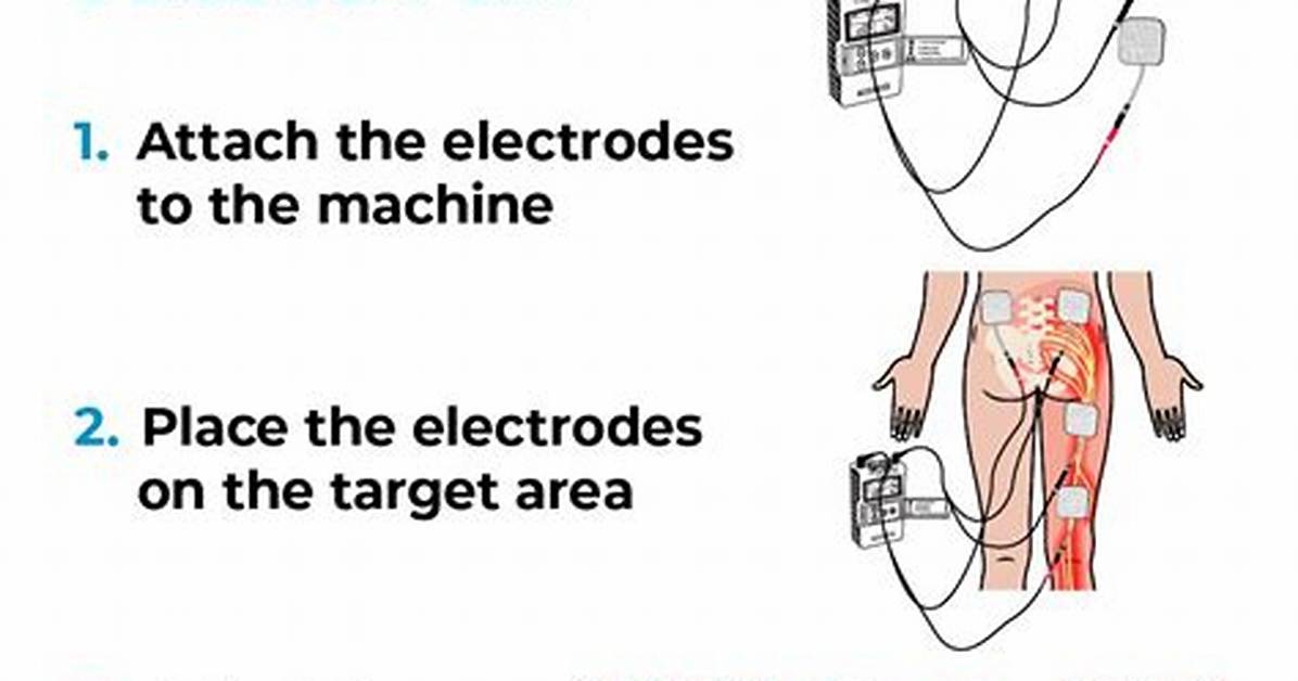 Tens Unit Placement for Sciatica