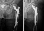 Tfn Surgery