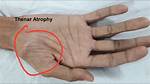 Thenar Atrophy