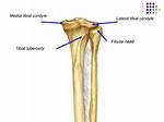 Tibial Condyle