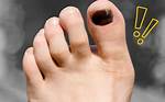 Toenails Falling Off