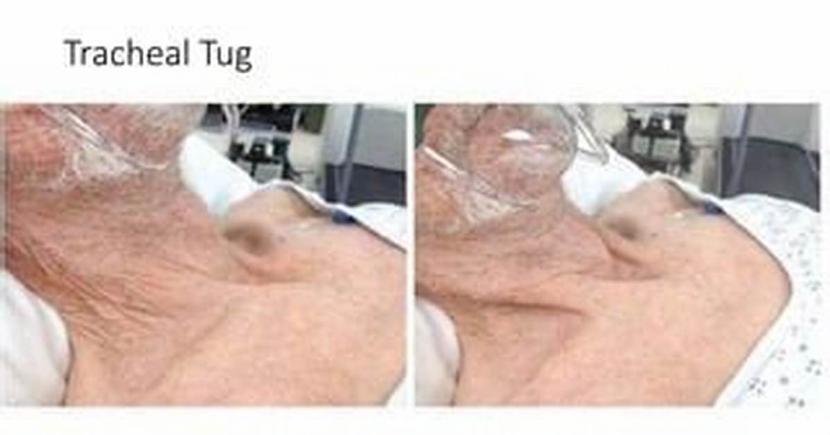 Tracheal Tug