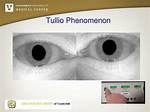 Tullio Phenomenon