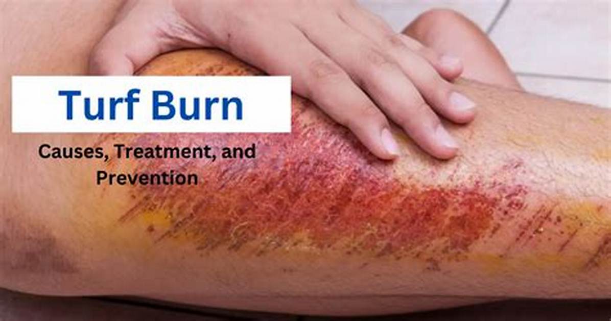 Turf Burn
