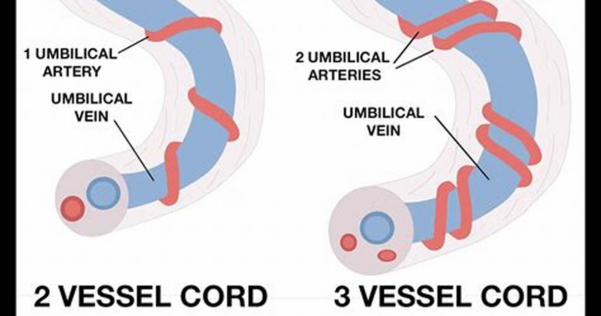 Two Vessel Cord