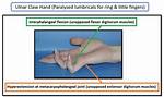 Ulnar Claw Hand