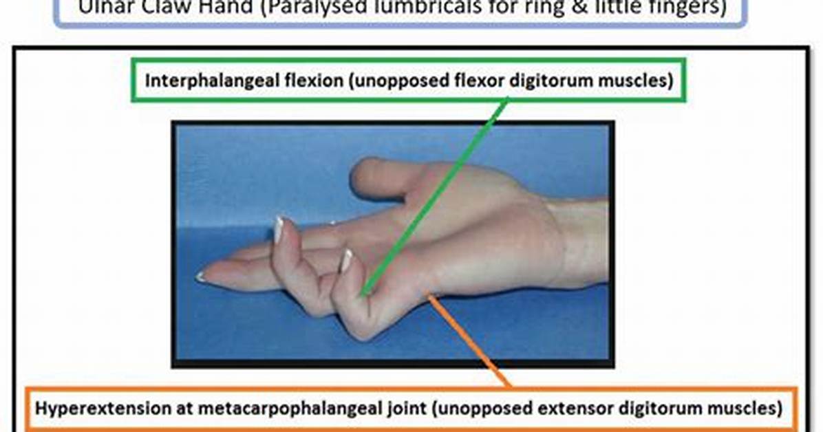 Ulnar Claw