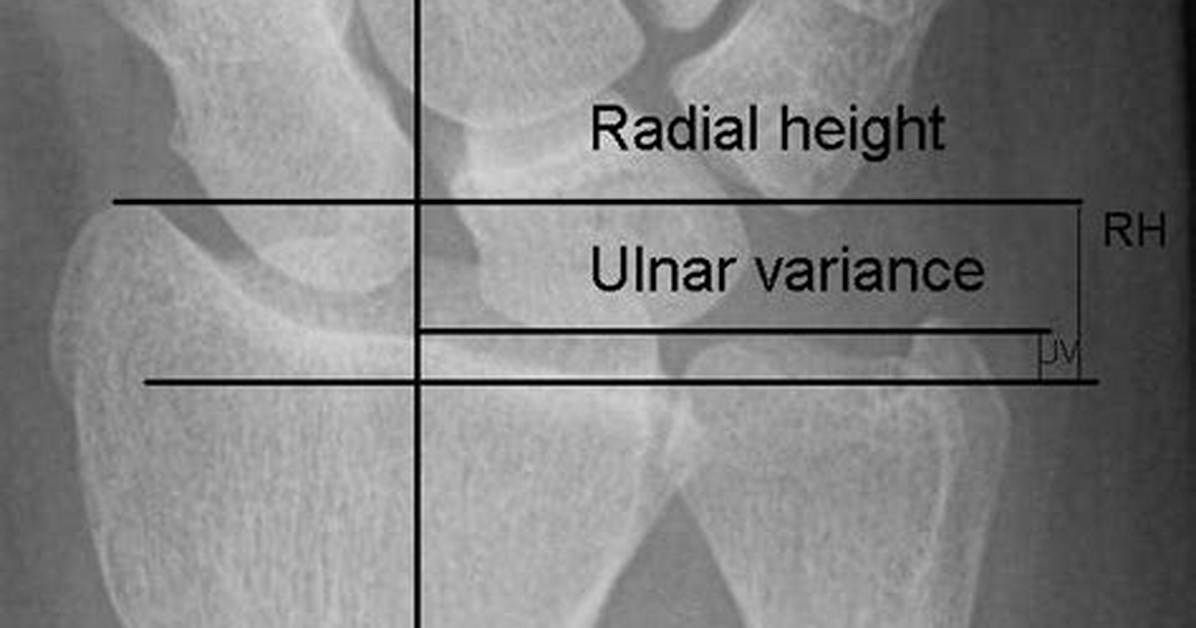 Ulnar Variance
