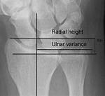 Ulnar Variance