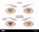 Unequal Pupils