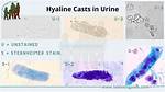 Urine Hyaline Casts
