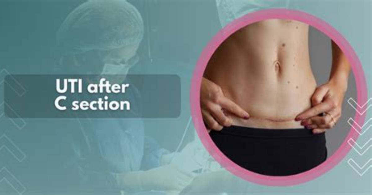 Uti After C Section