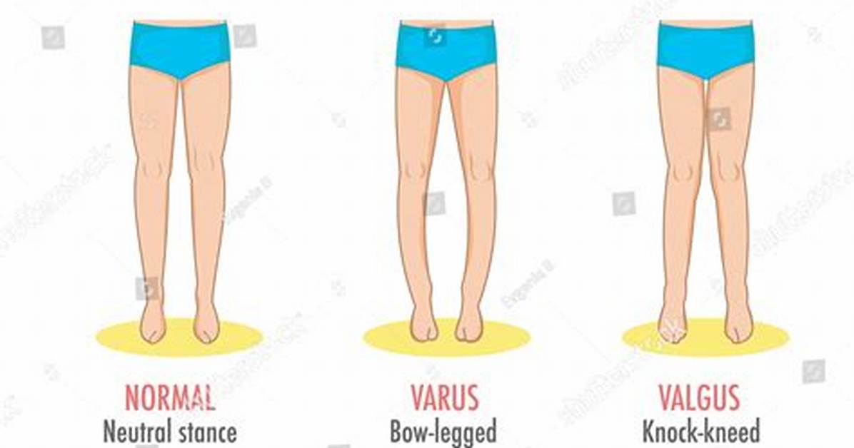 Varus Valgus