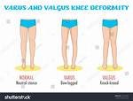 Varus Valgus