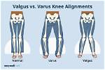 Varus vs Valgus