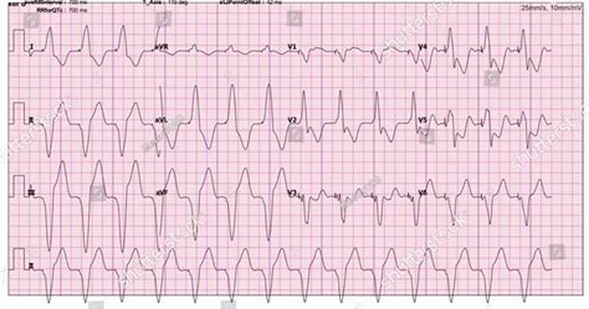 Ventricular Paced