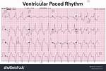 Ventricular Paced