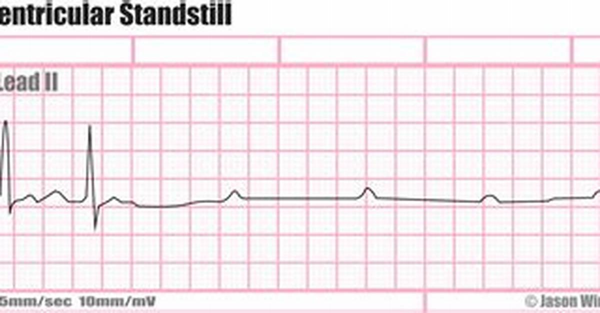 Ventricular Standstill