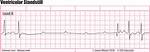 Ventricular Standstill