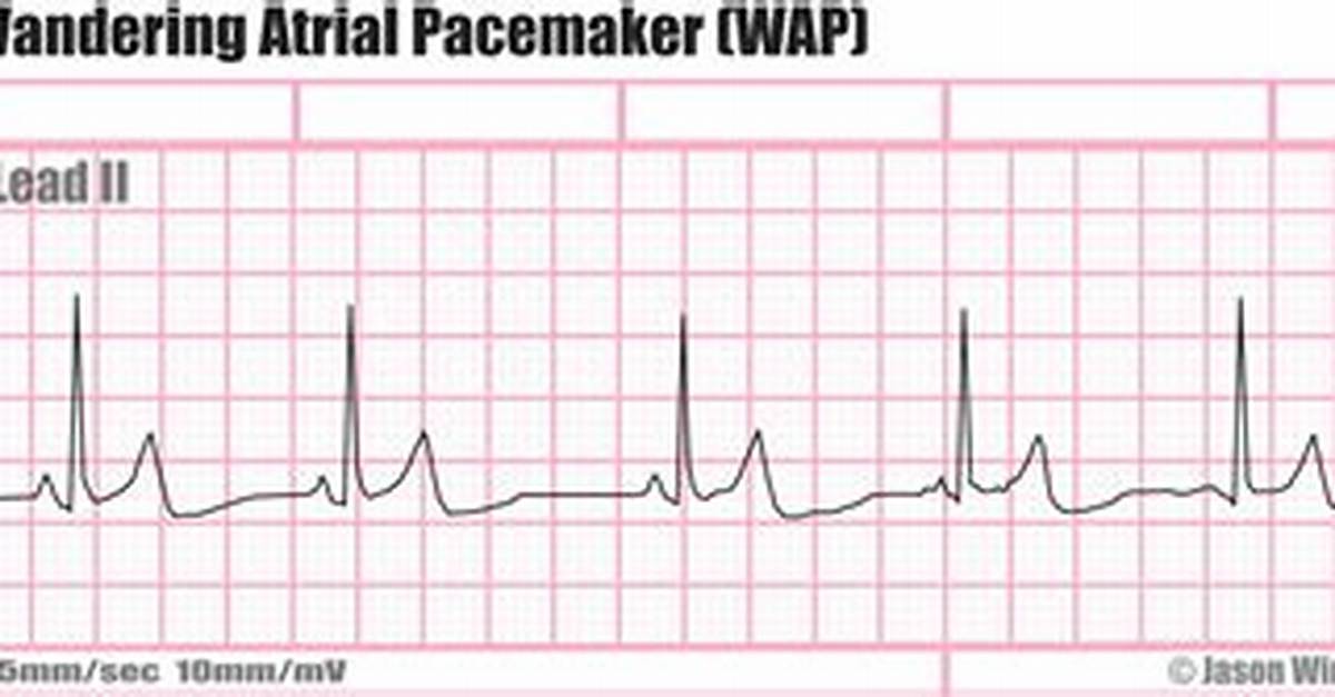 Wandering Pacemaker