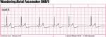 Wandering Pacemaker