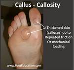 Was Does Calloused Mean?