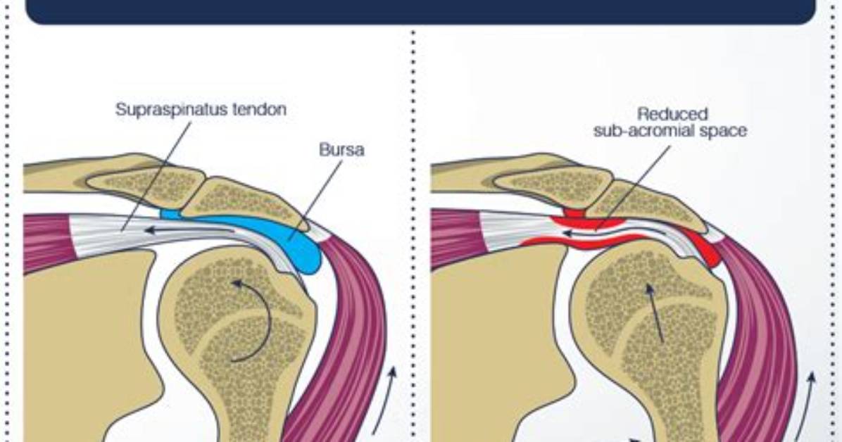 Was Does Impingement Mean?