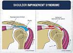 Was Does Impingement Mean?
