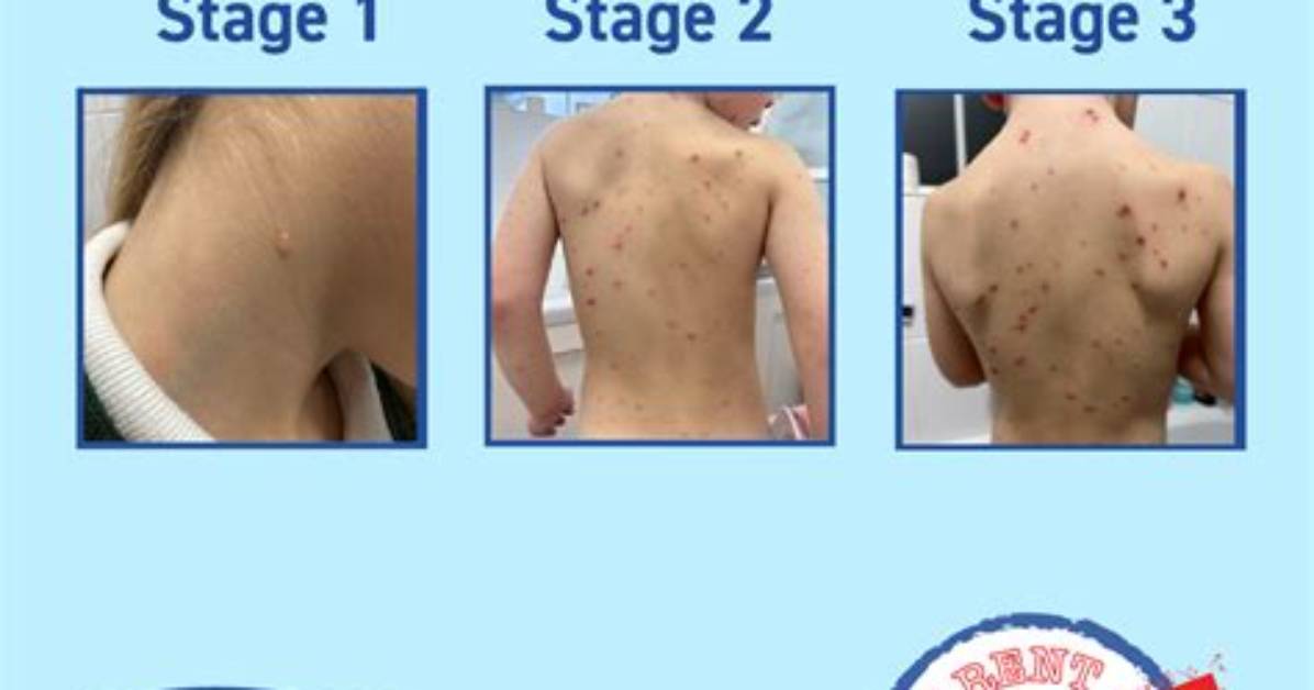 Were Do Chickenpox Start?