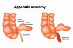 Were Is Your Appendix Located?