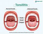 What Are 2+ Tonsils