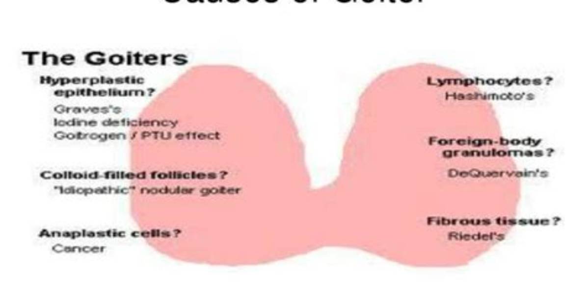 What Causes Diffuse Goiter