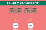 What Causes Double Vision