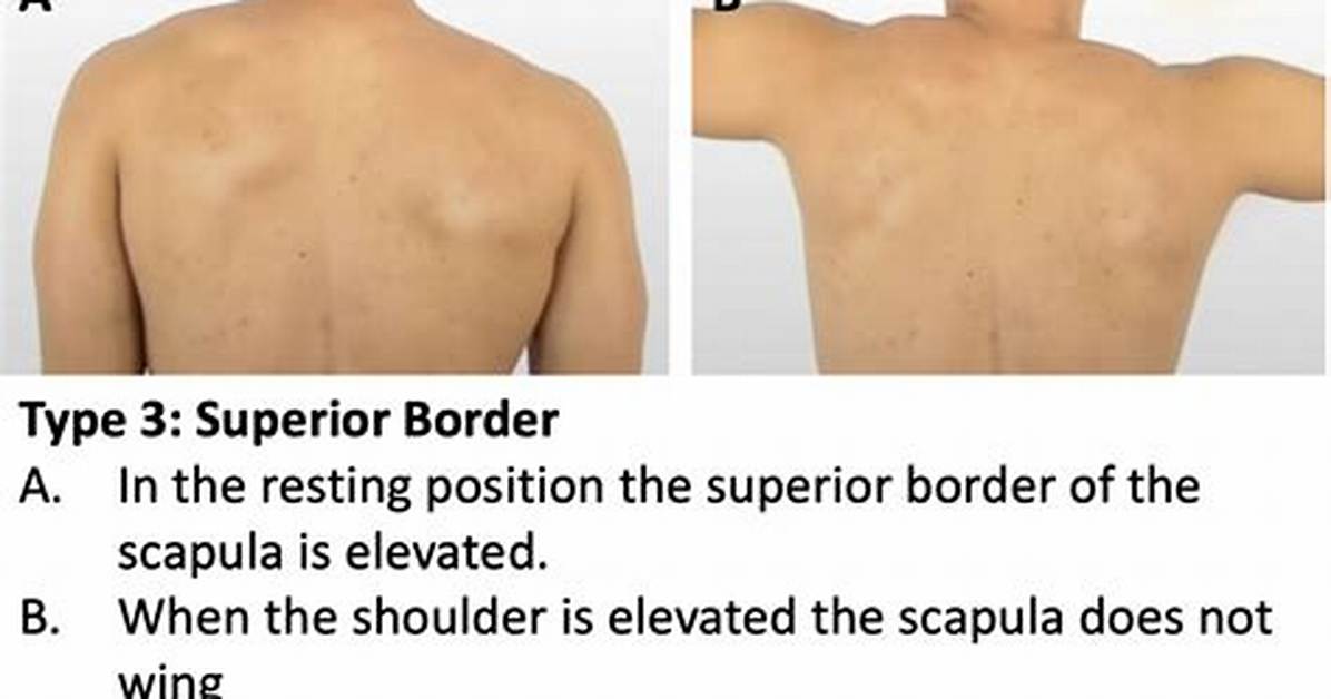 What Causes Elevated Shoulder?