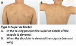 What Causes Elevated Shoulder?
