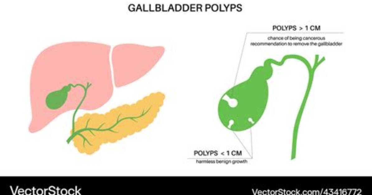 What Causes Gallbladder Polyps