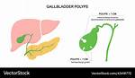 What Causes Gallbladder Polyps