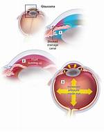 What Causes Glaucoma?
