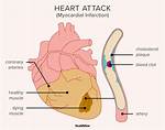What Causes Heart Attack